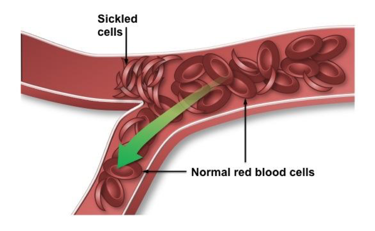 A sickle cell next to a healthy cell.
